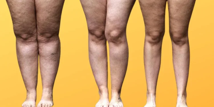 Lipedema e obesidade são a mesma coisa?
