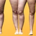 Lipedema e obesidade são a mesma coisa?