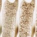Osteoporose: ortopedista revela hábito surpreendente que mais prejudica seus ossos