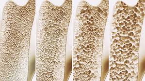 Osteoporose: ortopedista revela hábito surpreendente que mais prejudica seus ossos